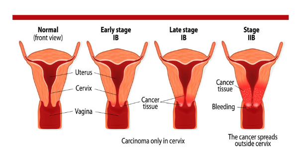 cervical_19.png